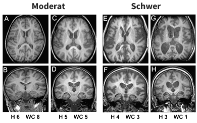 Brain MRI