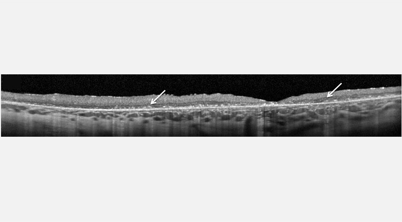 Untersuchung mittels optischer Kohärenztomographie (OCT)