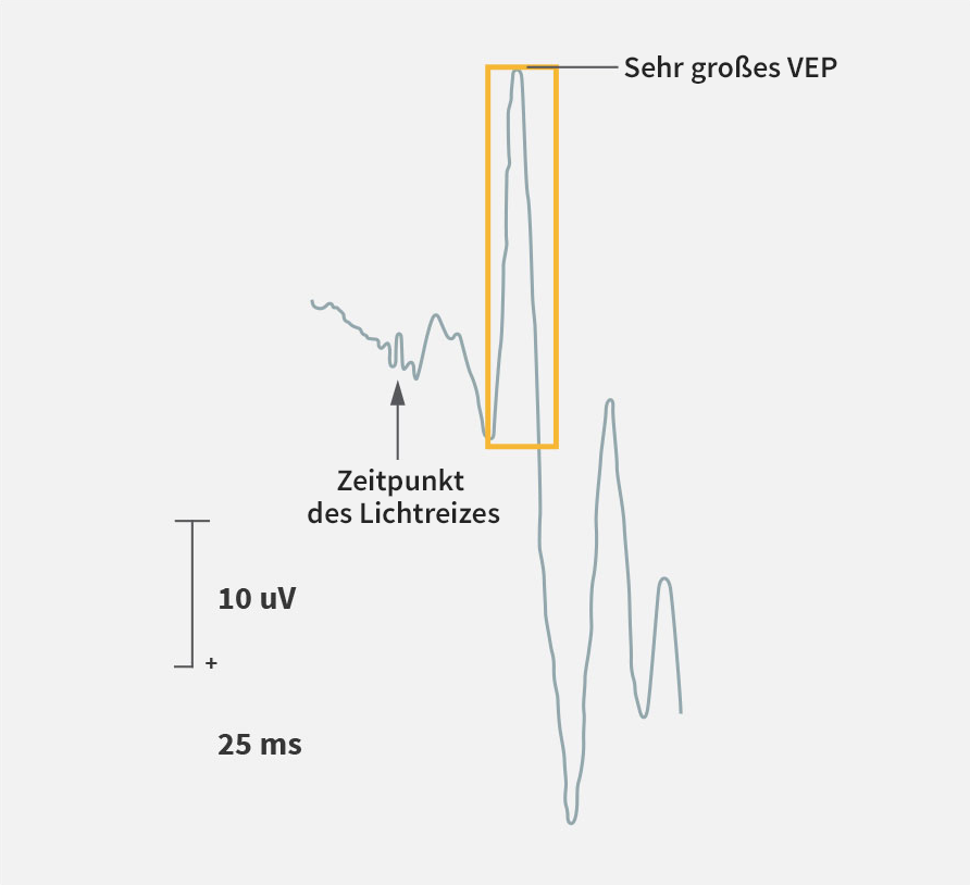 Untersuchung mittels visuell evozierter Potentiale (VEP)