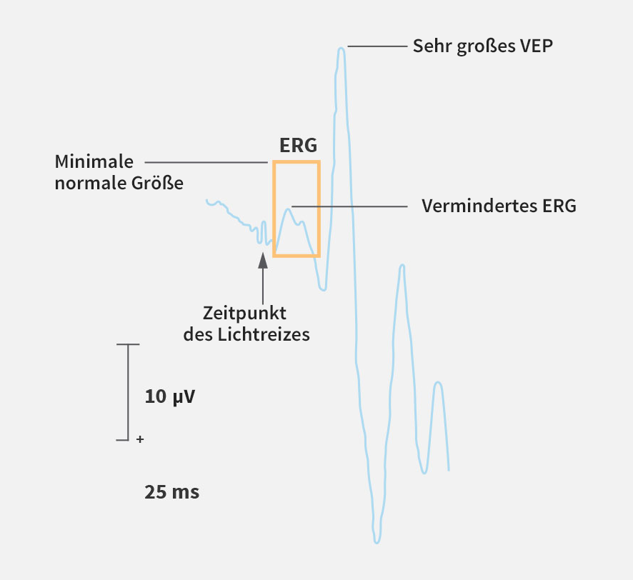 Untersuchung mittels Elektroretinogramm (ERG)