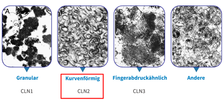 Ultrastrukturelle Erscheinungsbilder von NCL