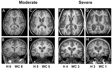 Brain MRI