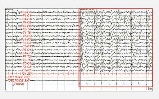 Electroencephalogram (EEG) assessment