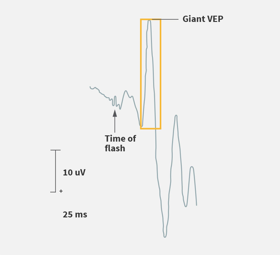 Visual evoked potential (VEP) assessment