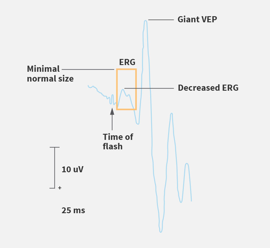 Electroretinogram (ERG) assessment