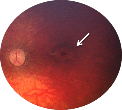 Angiografía con fluoresceína (AF)