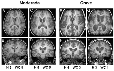 Brain MRI