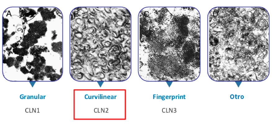 Aspecto de las ultraestructuras de la LCN (Lipofuscinosis Ceroidea Neuronal)