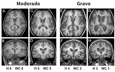 Brain MRI
