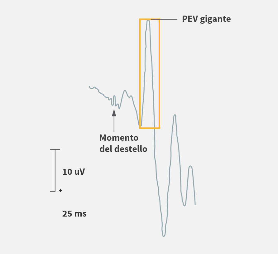 Evaluación de potencial evocado visual (PEV)