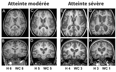 Brain MRI