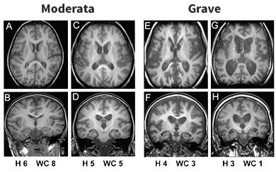 Brain MRI