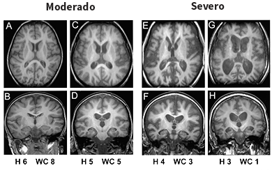 Brain MRI