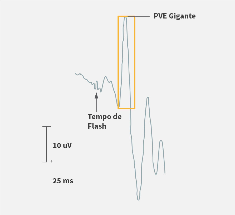 Gráfico de potencial visual evocado (PVE)