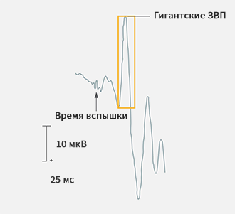 Зрительные вызванные потенциалы (ЗВП)