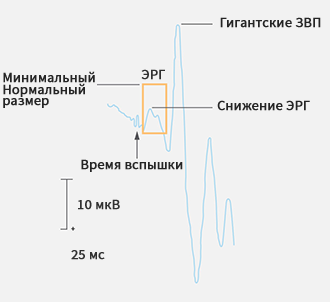 Электроретинография (ЭРГ)