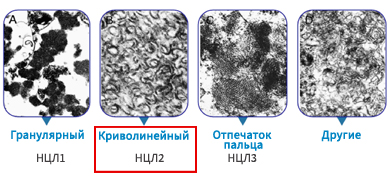 Ультраструктурная морфология НЦЛ