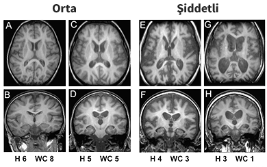 Brain MRI